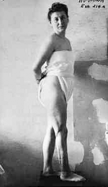 Ravensbrück survivor, Jadwiga Dzido (1918−1985) revealing the scars to her leg caused by Nazi medical experiments. Photo by anonymous (c. 1946). PD-No Copyright Notice. Wikimedia Commons.